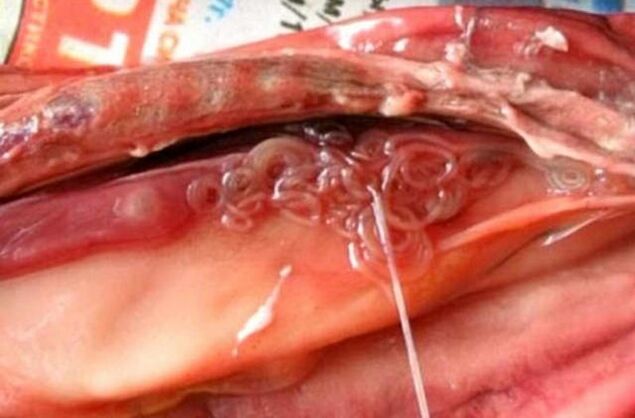 fluke in the gallbladder